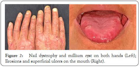 Epidermolysis Bullosa Acquisita A Case Report