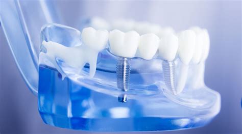 Revolutionize Your Smile A Journey Through Whole Set Of Teeth Implants