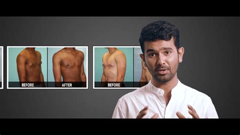 Gynecomastia Male Breast Correction Youtube