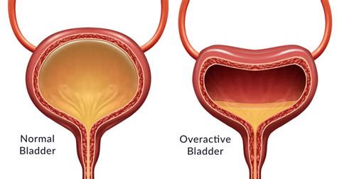 What Is Bladder Retraining Pelvic Health Physical Therapy Morris