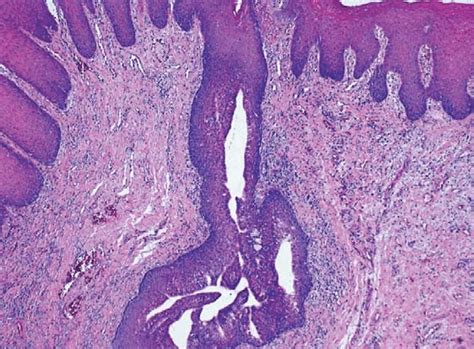 Vista Microsc Pica De La Hiperplasia Fibrosa Inflamatoria Mostrando