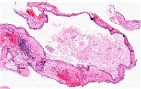 Pathology Outlines Odontogenic Keratocyst