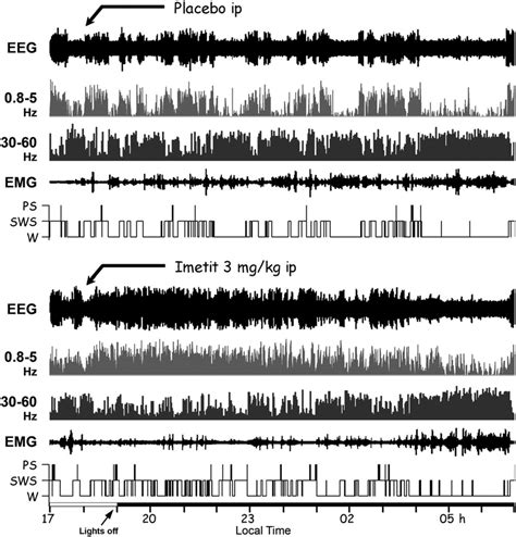 Typical Examples Of Polygraphic Recordings Cortical Eeg Power