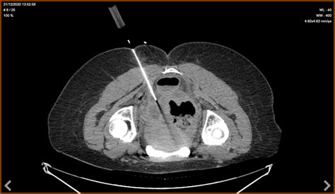 Drainage Sous Echographie Ou Sous Scanner Hopital Cr Teil Grand Paris