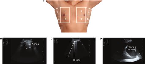 A 8 Zone Lung Ultrasound Probe Positions B A Lines Or Normal Lung Download Scientific