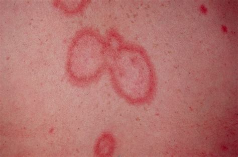 Cutaneous Lupus Erythematosus Pictures 4 Subacute Cutaneous Lupus