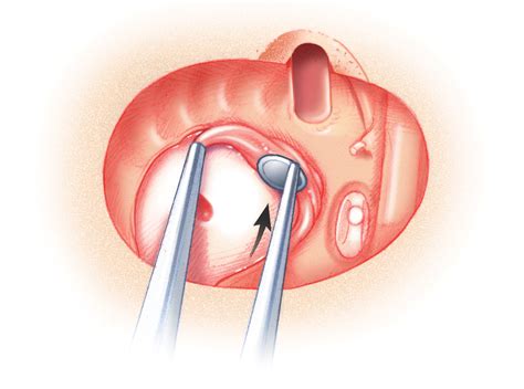 Cerebrospinal Fluid Leak Skull Base Surgery Atlas