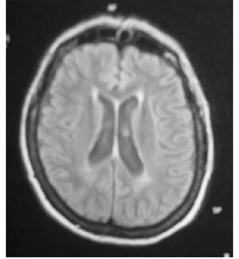 Brain MRI on flair-weighted image. Periventricular white matter high ...