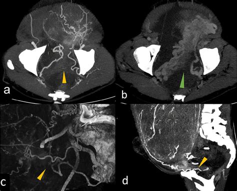 Axial Computed Tomography Ct Maximum Intensity Projection Mip