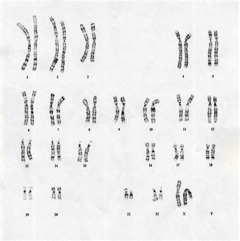 Abnormal Karyotype; Karyotype, Abnormal