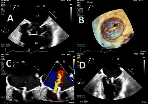 A Two Dimensional Transesophageal Echocardiography TEE