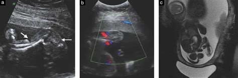 Fetoscopic Release Of Umbilical Cord Amniotic Band In A Human Fetus