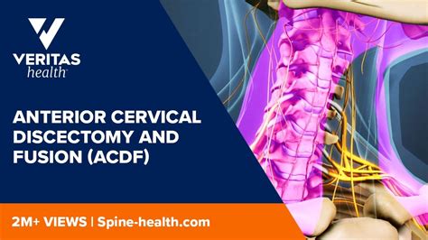 Anterior Cervical Discectomy And Fusion Acdf Youtube