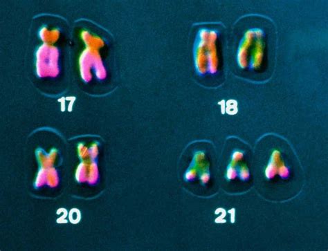 Oldest Case Of Downs Syndrome From Medieval France New Scientist