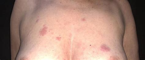 Papules Lymphoma