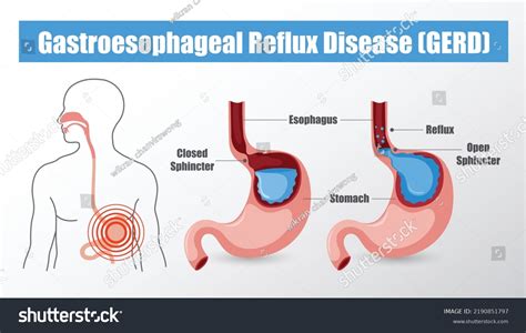 Gastroesophageal Reflux Disease Icon Vector Illustration Stock Vector