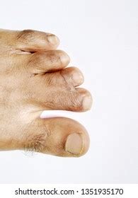 48 Imagens De Toe Dactylitis Imagens Fotos Stock E Vetores Shutterstock