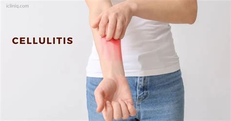 Cellulitis Causes Symptoms Risks Diagnosis Treatment Home Remedies