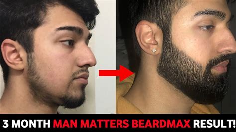 3 Month Beard Growth Minoxidil Journey Minoxidil Review Beard Growth