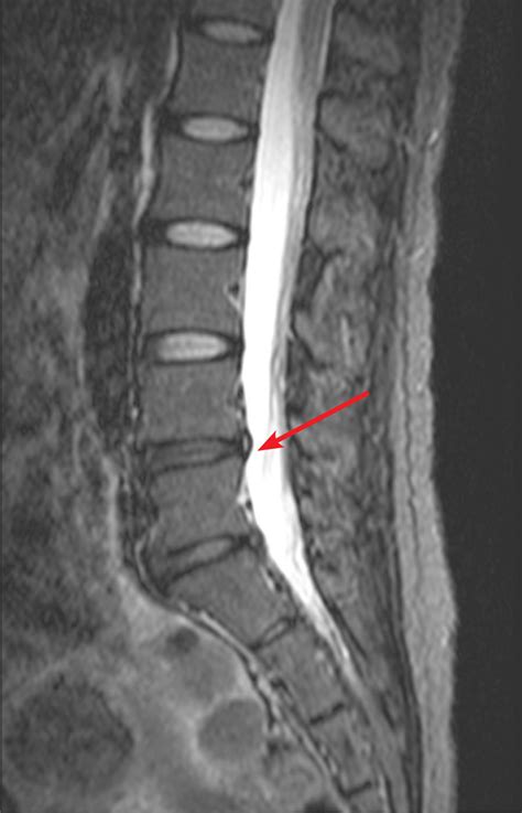 Annular Tear Or Fissure Ehealthstar