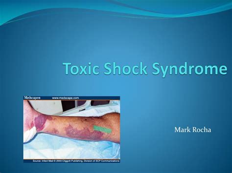 Ppt Toxic Shock Syndrome Powerpoint Presentation Free Download Id