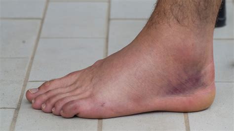 Grade 1 Ankle Sprain Swelling