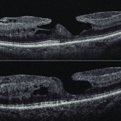 A B Trace Epiretinal Fluid Within A Lamellar Macular Hole Associated Download Scientific