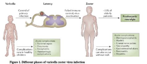 Herpes Zoster Flashcards Quizlet