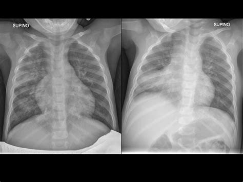 Chest X Ray In The Supine Position Of A 2 Year Old Patient Where Download Scientific Diagram