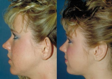 Otoplasty Beeson Cosmetic Surgery