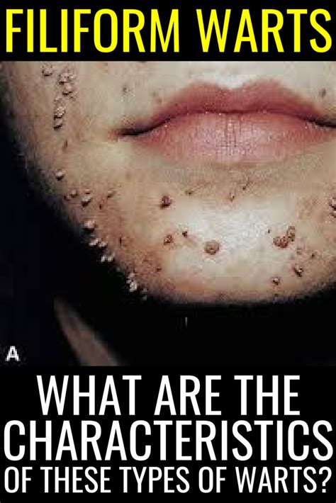 Filiform Warts - What Are the Characteristics of These Types of Warts?