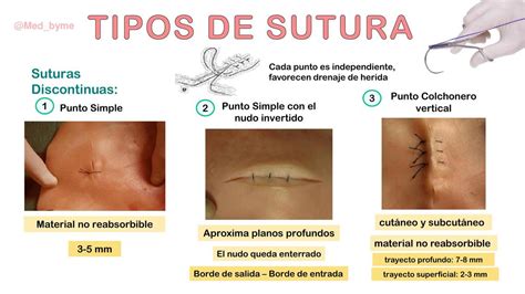 Tipos De Suturas Medbyme Udocz