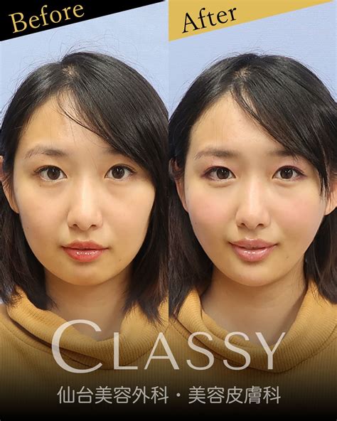 仙台で小顔にしたい！小顔vフェイスリフト（溶ける糸によるリフトアップ） Classy 仙台美容外科・美容皮膚科