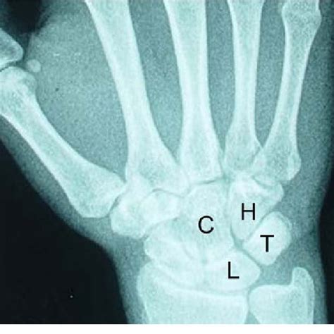 Plain Postero Anterior Radiograph Of The Wrist Showing A Type II