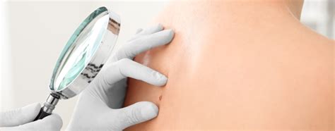 Skin Cancer Prevention & Treatment - Affiliated Dermatology