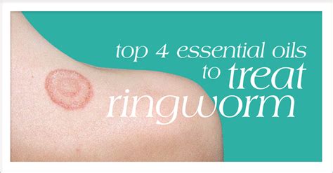 Ringworm In Kids: The Parent's Guide To Symptoms And, 60% OFF