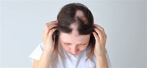 Female Pattern Baldness Causes And Treatments