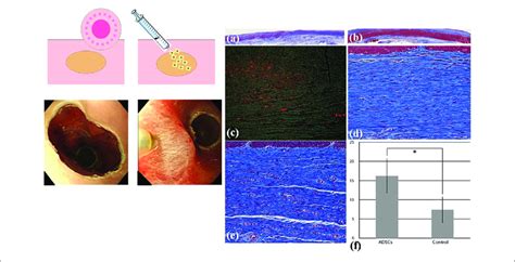 Adipose Tissue Derived Stromal Celladsc Injection To Prevent