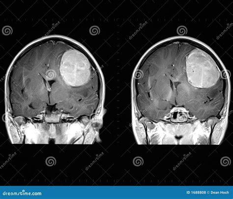 Mri Del Cervello Che Mostra Tumore Fotografia Stock Immagine Di