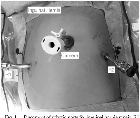 Figure 1 From Robotic Inguinal Hernia Repair Technique And Early