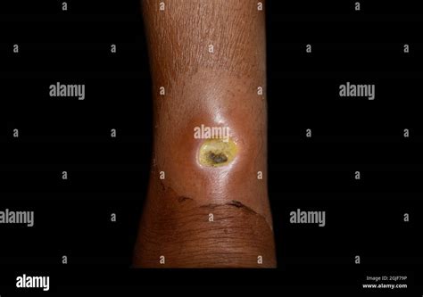 Leg Ulcer Immagini E Fotografie Stock Ad Alta Risoluzione Alamy