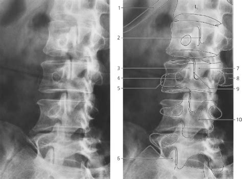 Spine Radiology Key