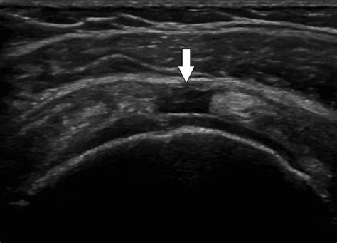 Ultrasound Guided Subacromialsubdeltoid Bursa Corticosteroid