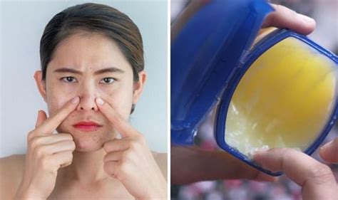 Blackhead Removal Hack Why You Should Never Use Vaseline To Get Rid Of Blackheads Uk