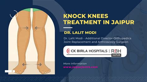 Knock Knees Treatment in Jaipur By Dr. Lalit Modi | JaipurJoints