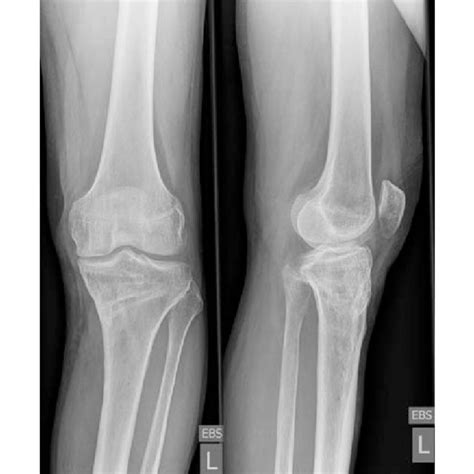 Anteroposterior And Lateral Radiographs Of The Left Knee Joint After Download Scientific