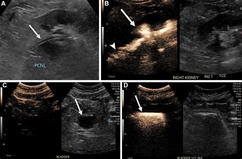 Nontraditional Uses Of US Contrast Agents In Abdominal Imaging And