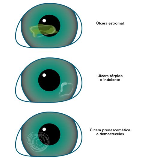 Girar Restante Descomponer Ulcera En El Ojo Imagenes Dime Cubrir Consola