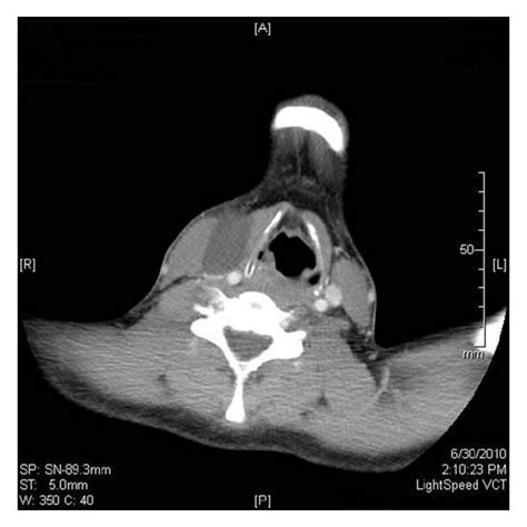 Axial Ct Scan With Contrast Showing The Cystic Neck Mass Lateral To The Download Scientific