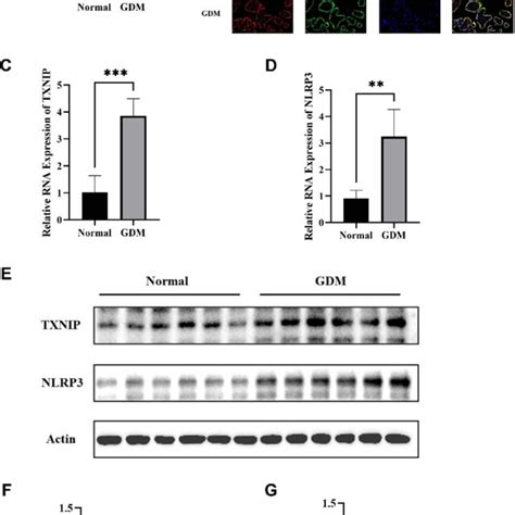 Mir P Txnip And Nlrp Expression In Placental Tissues In Gdm Group